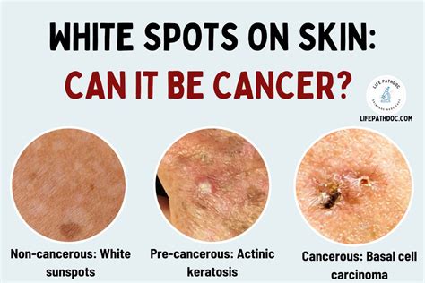 White Spots on the Skin: Can it be Cancer?