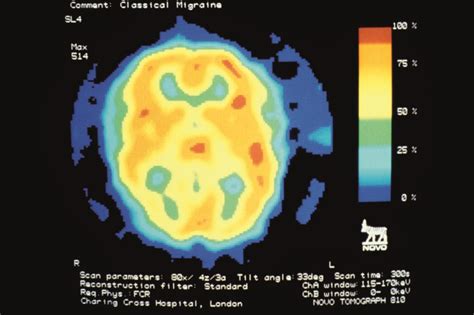 Study questions perceived stroke risk of some migraine drugs - The Pharmaceutical Journal