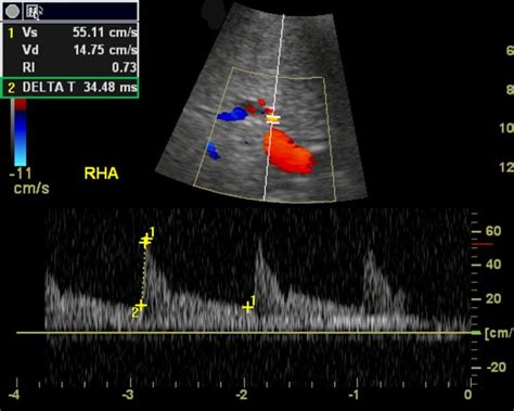 Normal hepatic artery. Spectral Doppler image in a liver transplant patient shows a normal ...