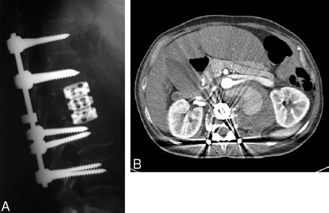 Patient (No. 8) with a secondary false aneurysm at the level of the... | Download Scientific Diagram