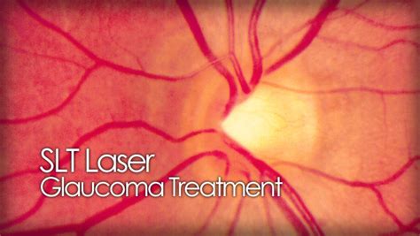 SLT laser procedure for glaucoma