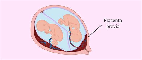 Twin- pregnancy with placenta previa