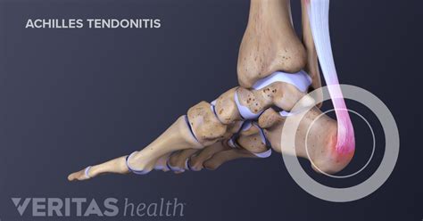 Achilles Tendon Conditions Signs and Symptoms