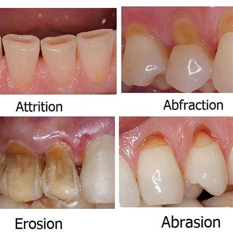 Difference between dental erosion, enamel attrition, abfraction and ...