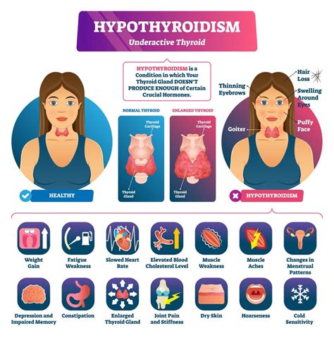 Nutrition in hypothyroidism