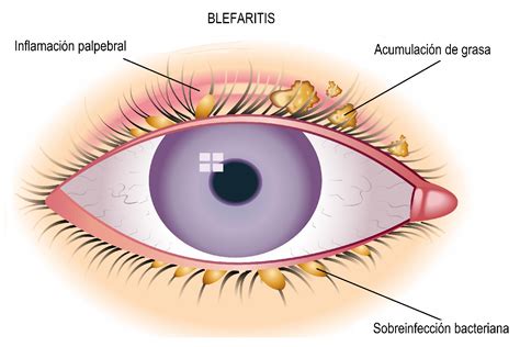 Momento Aditivo Frágil inflamacion conjuntiva palpebral Trampolín ...
