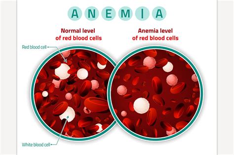 Anemia level of blood cells | Healthcare Illustrations ~ Creative Market