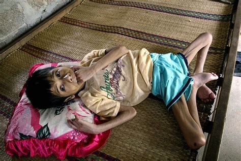 Agent Orange Victims: Haunting Photos Of The Unpunished War Crimes Of U ...