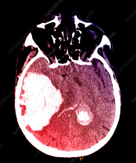 Massive Intracranial Hemorrhage, CT Scan - Stock Image - C027/1772 ...