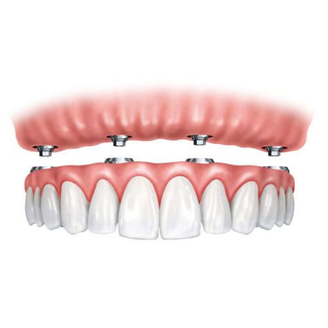 Implant-Supported Dentures Near Me | Lincoln, MA 01773