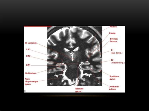 Mesial temporal lobe epilepsy