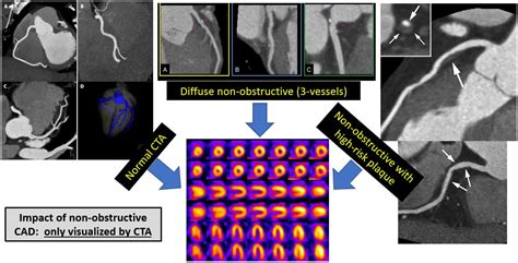 Coronary CTA Should Be the Initial Test in Most Patients With Stable ...