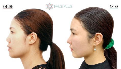 Nose Revision Surgery – Face Plus Clinic Korea