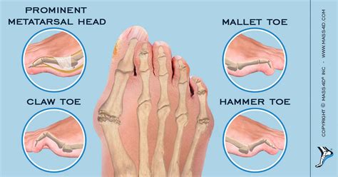 Types Of Foot Deformity