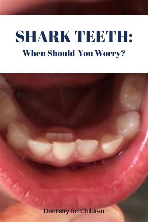 Shark Teeth: When Should You Worry? | Dentistry For Children