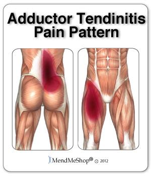 Groin Tendinitis