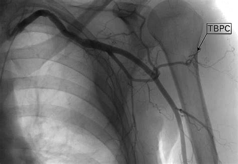 Posterior Circumflex Humeral Artery Cadaver