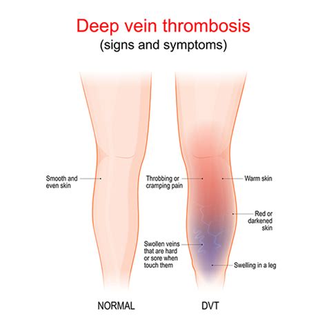 Deep Vein Thrombosis (DVT) – New York Vein Treatment Center