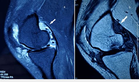 MRI of left knee shows diffuse nodular synovial hypertrophy in T2W (a ...