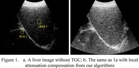 Figure 1 from Estimation of Ultrasound Attenuation and its Application to Tissue Heterogeneity ...