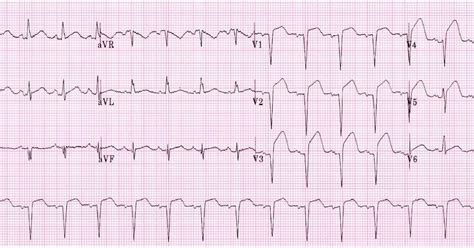 Study Medical Photos: Acute Anterior Myocardial Infarction - ECG