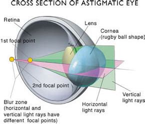 CIBA Vision Bifocal Lenses - Lenses for Astigmatism - Specialty & Prosthetic Lenses