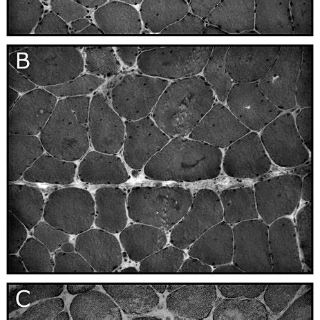 Histological findings in myofibrillar myopathies. Muscle fibers with ...