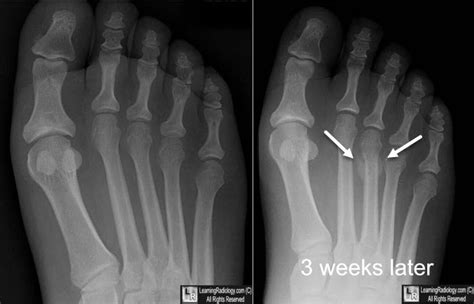 LearningRadiology - stress, fracture, march, foot