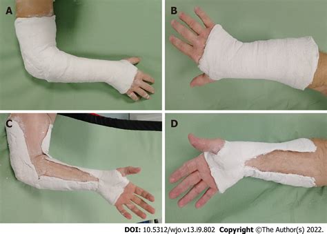 Short arm cast is as effective as long arm cast in maintaining distal ...