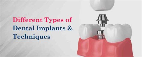 Who owns hiossen dental implants - Dental News Network