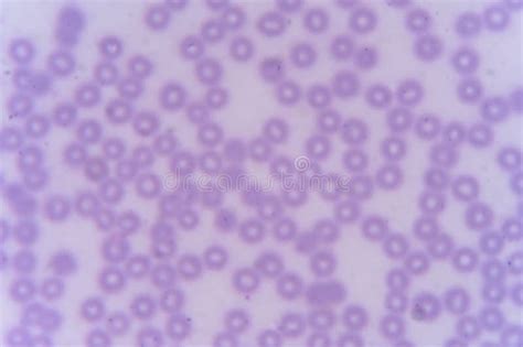 Blood Smear : Red Blood Cells Stock Photo - Image of sample, medical: 46373124