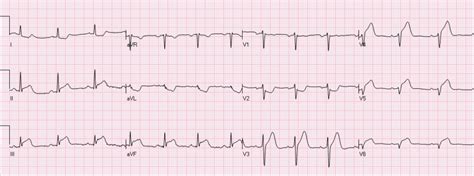 The Importance of Reciprocal Changes in aVL - REBEL EM - Emergency ...