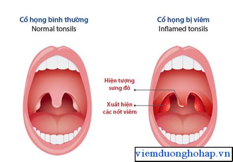 Cổ họng có hạt đỏ - nguy hiểm chớ bỏ qua