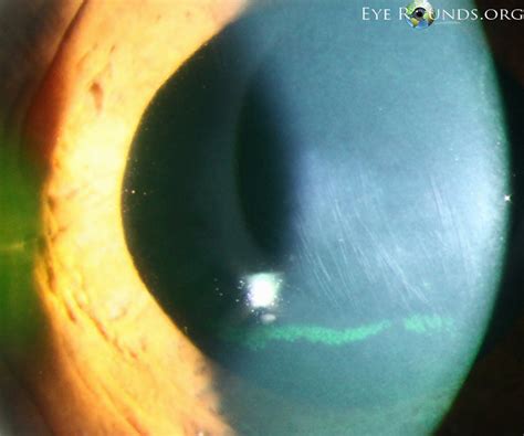 Atlas Entry - Vogt's striae in keratoconus