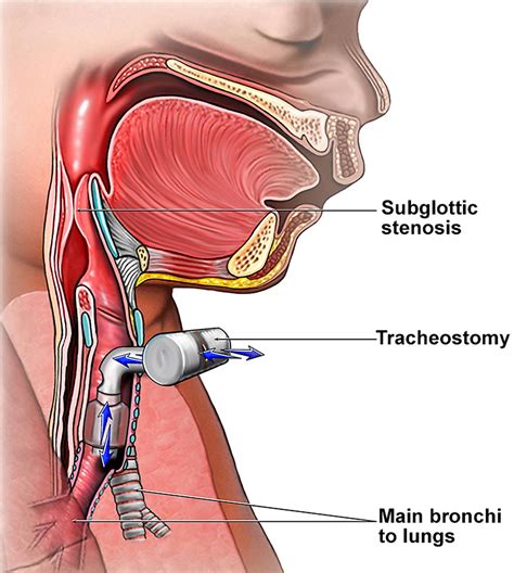 Tracheostomy - Procedure, Care, Tracheostomy Complications