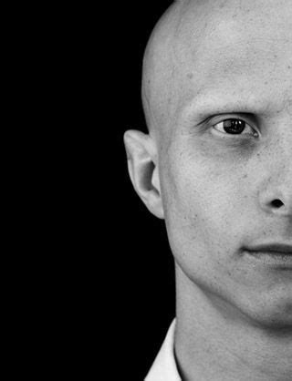 137 best images about Alopecia on Pinterest | Hair loss, Joanna rowsell and Is beautiful