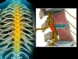 Thoracic Nerve Compression Harris County, TX | Spinal Compression Angelina County, TX