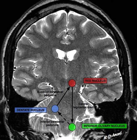 Triangle of Guillain and Mollaret | Radiology Reference Article | Radiopaedia.org | Radiology ...