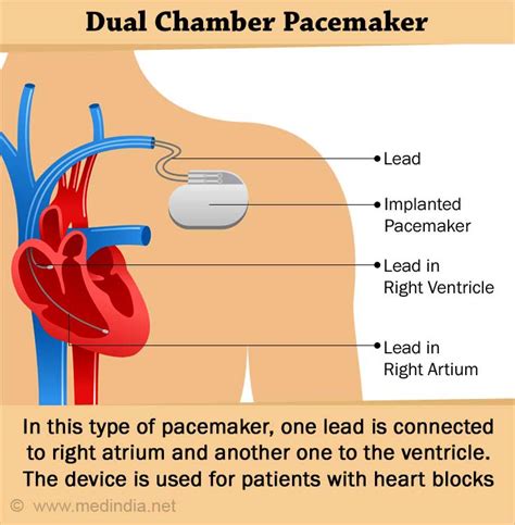 Cardiac Pacemaker for Abnormal Heart Rhythms – Types, Advantages, Risks