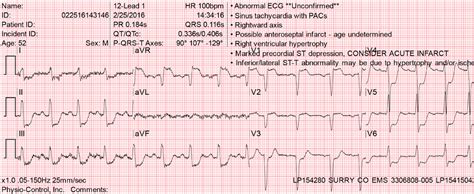 Dr. Smith's ECG Blog: Diffuse Subendocardial Ischemia on the ECG. Left main? 3-vessel disease? No!