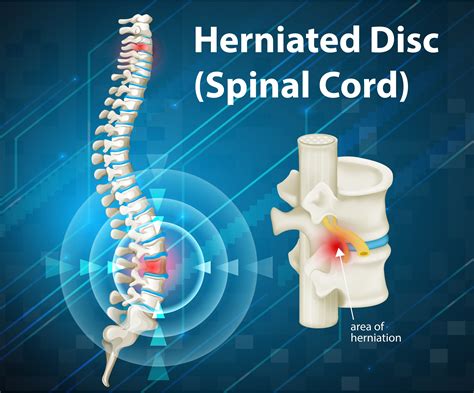 What Is a Herniated Disc? (Signs and Symptoms)