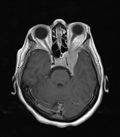 Sphenoid wing meningioma | Radiology Case | Radiopaedia.org