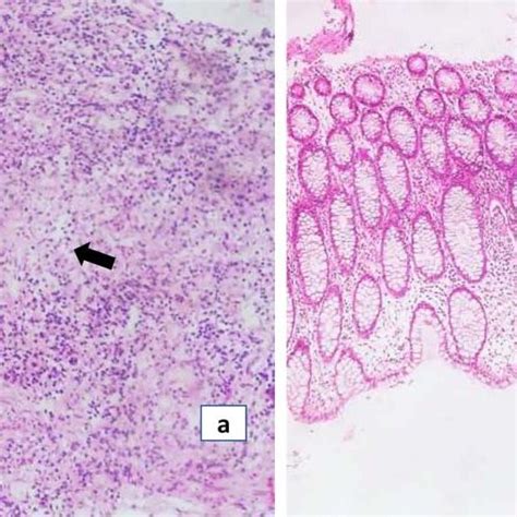 Ileocolic resection showing an edematous terminal ileum with ...