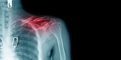 Surgical Treatment for Clavicle Fracture | EmergeOrtho—Triangle Region