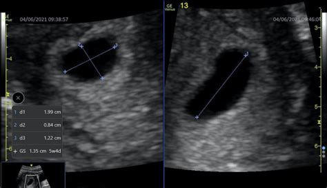 [Figure, Measurement of this gestational sac...] - StatPearls - NCBI ...