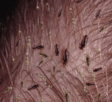 Head Lice - Walk-in Dermatology