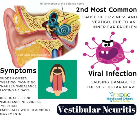 What Is Vestibular Neuritis? Symptoms, Causes, Diagnosis, Treatment, and Prevention | Health ...