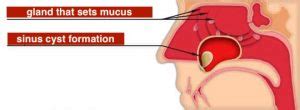 Nasal cyst (sinus cyst): types and methods of treatment