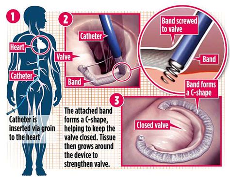 Pioneering keyhole procedure that seals leaking heart valves | Daily Mail Online