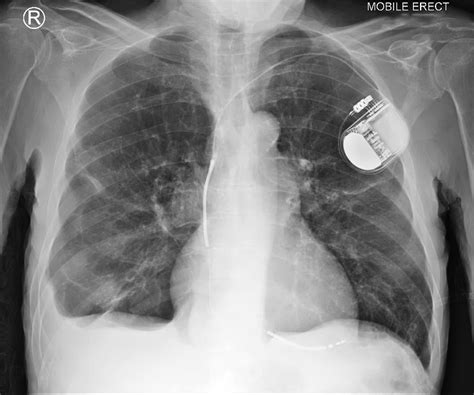 Cardiac Devices on Chest X-Ray | Chest X-Ray - MedSchool